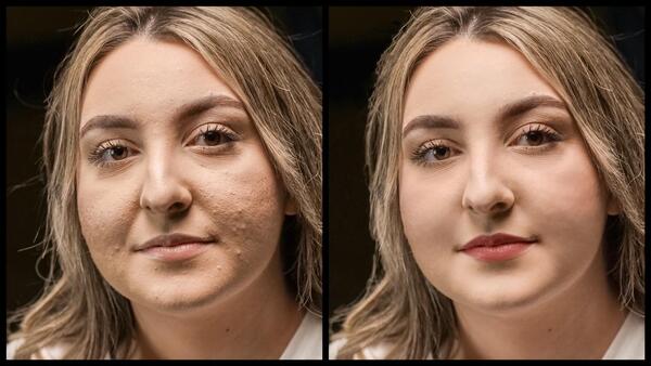 Montagem com 2 fotos da mesma mulher com marcas de espinha no rosto mostrando o antes e depois da edição do Airbrush