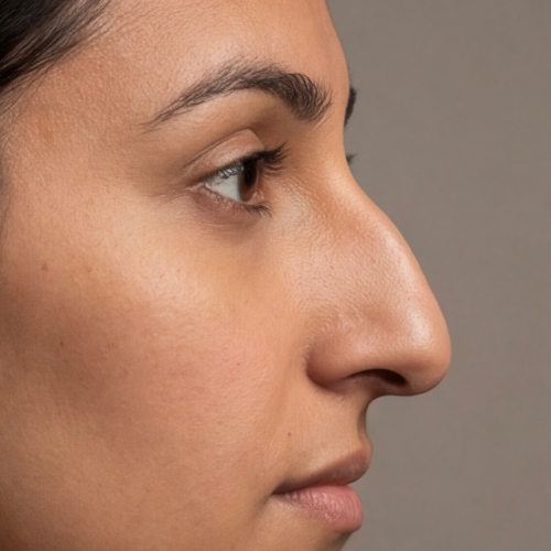 nose types - aquiline